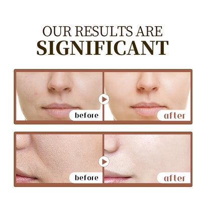 Madagascar Centella Asiatica Serum 55ml - Fórmula calmante para pele sensível com suporte para acne e hidratação profunda para o rosto.✨💎🌿